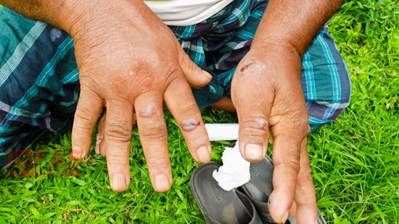 গাইবান্ধায় গরুর মাংস খেয়ে আরও ৩ জনের অ্যানথ্রাক্সের উপসর্গ